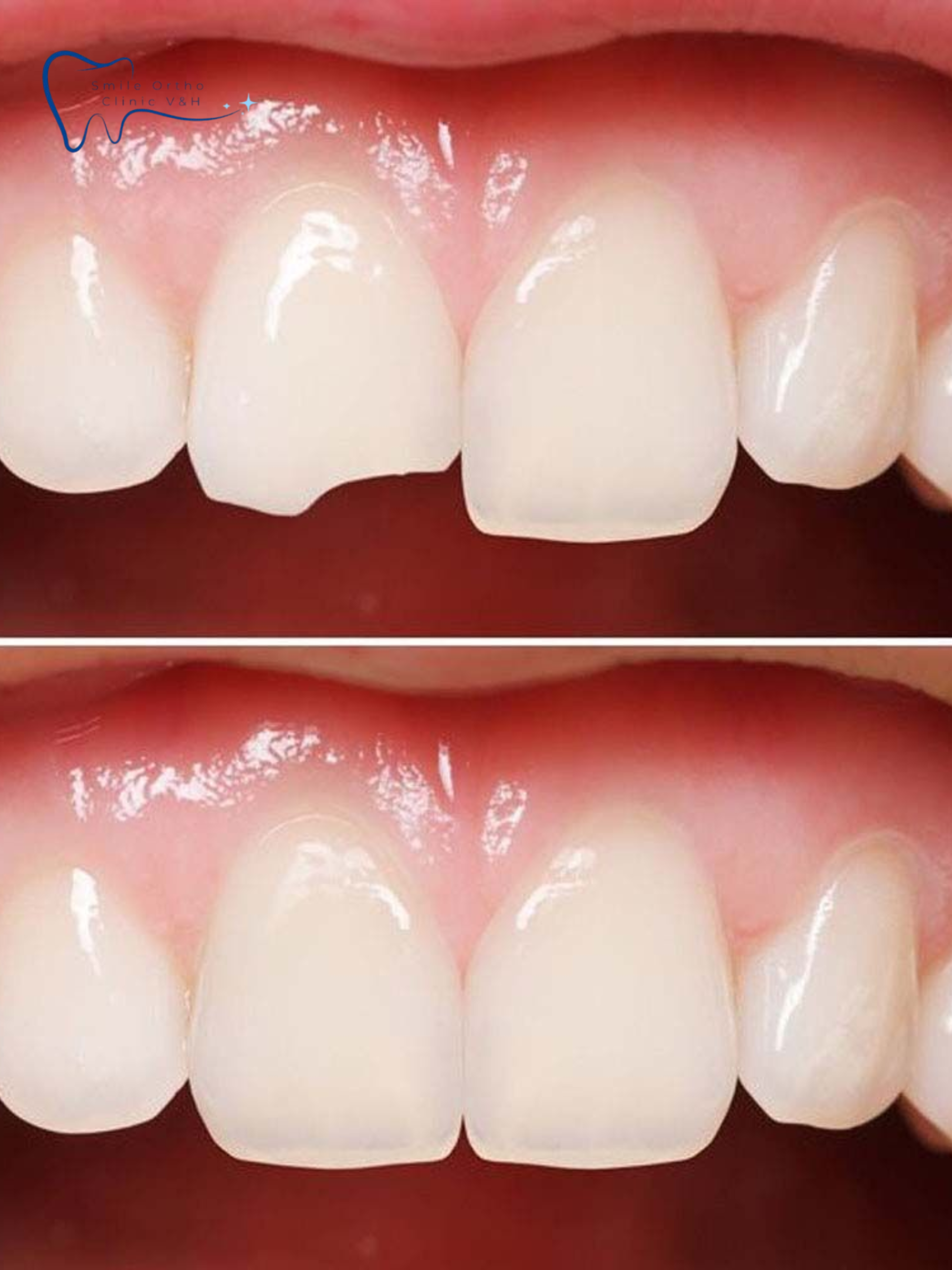 TRÁM RĂNG THẨM MỸ COMPOSITE